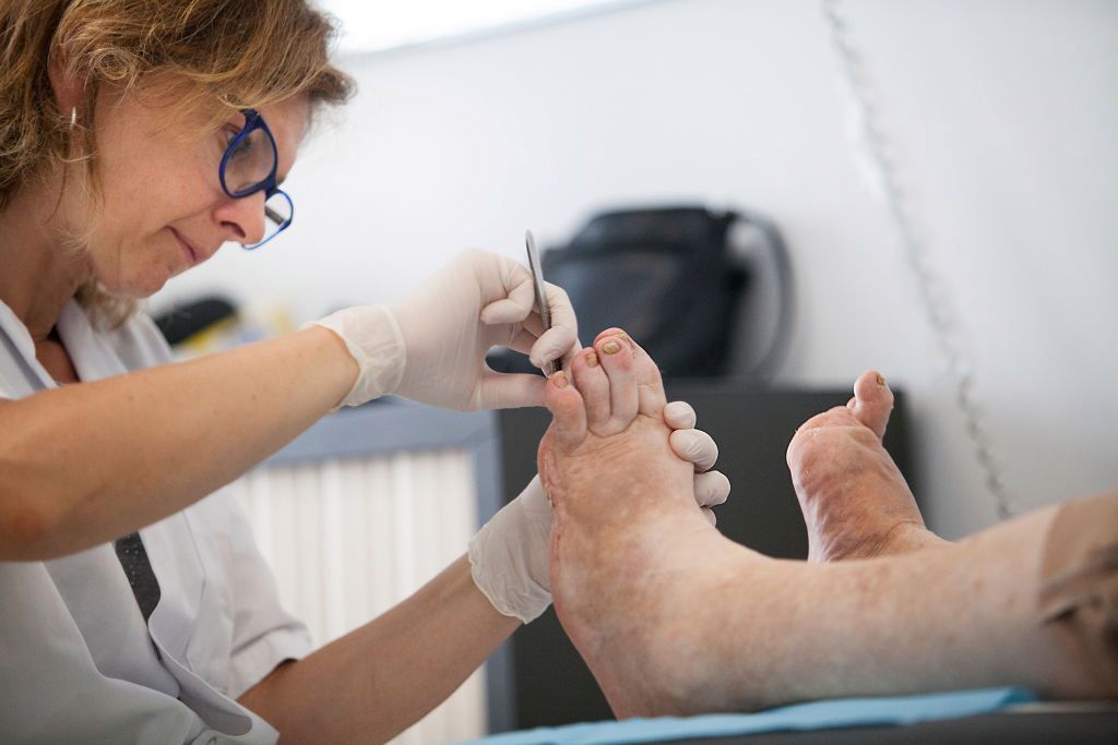 Cukrzyca może powodować deformację stóp