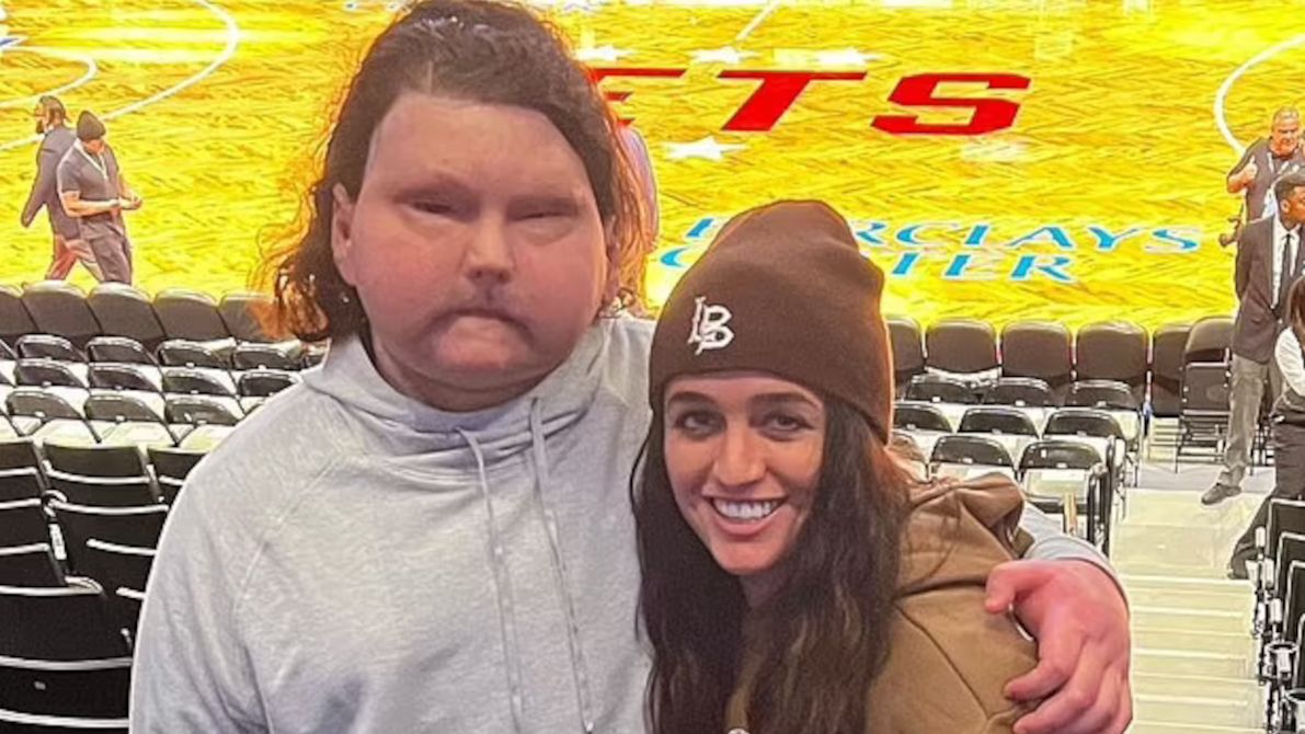 Przeszedł pierwszy na świecie przeszczep twarzy.