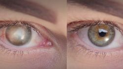 Niewidomy odzyskał wzrok po 10 latach, dzięki przeszczepowi sztucznej rogówki