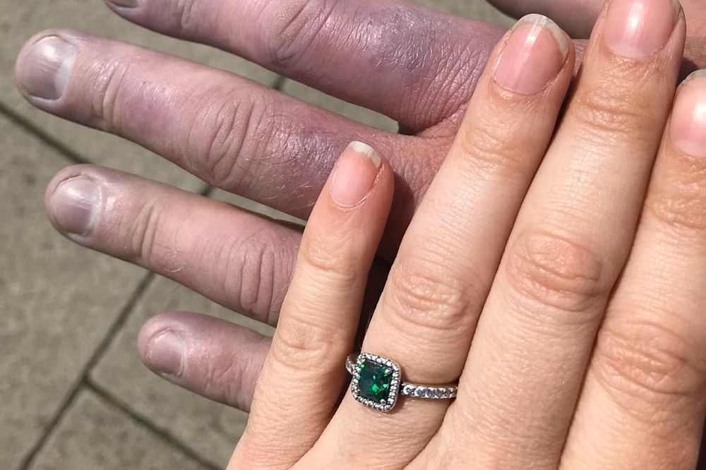 Wygląd dłoni ostrzegał o chorobie