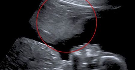 "Anioł stróż" czuwał nad jej ciążą. Niezwykłe zdjęcie USG