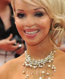 Katie Piper została oblana kwasem. Pokazała fotografię po operacji