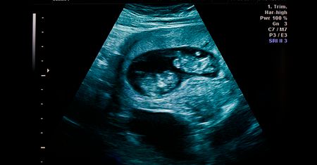 Tragiczny błąd brytyjskich lekarzy. Abortowali zdrowego bliźniaka