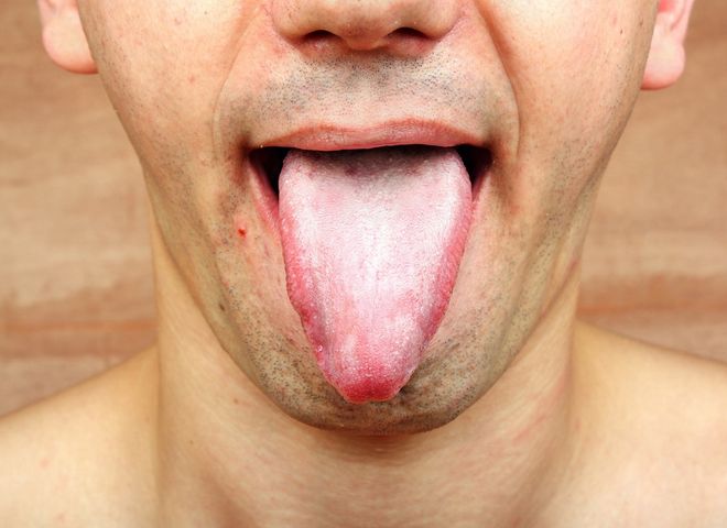 Covidowy język. nowy objawy COVID-19