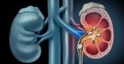Kamica nerkowa - przyczyny, objawy, leczenie