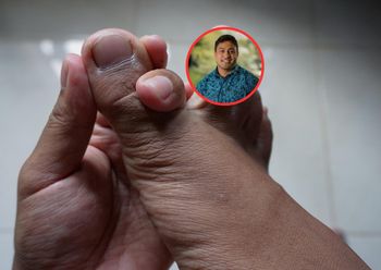 Główna przyczyna dny moczanowej. TikTok wprowadza w błąd ws. leczenia