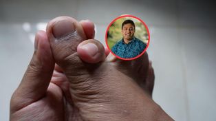 Główna przyczyna dny moczanowej. TikTok wprowadza w błąd ws. leczenia