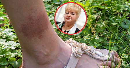 Dziecięca choroba atakuje dorosłych. "Mam coraz więcej takich chorych"