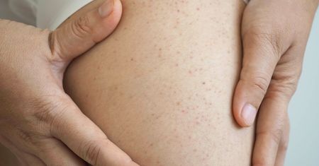 Trombocytopenia. Przyczyny, objawy i leczenie