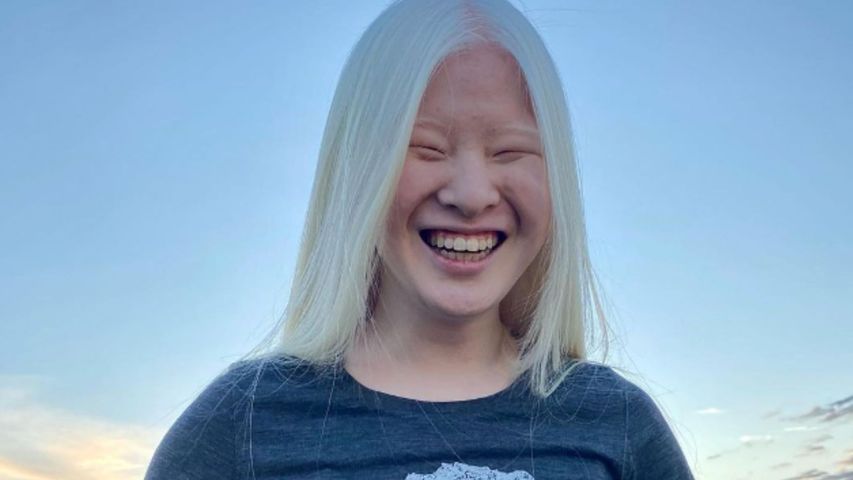 Dziewczyna porzucona przez rodziców z powodu albinizmu dziś robi karierę jako fotomodelka