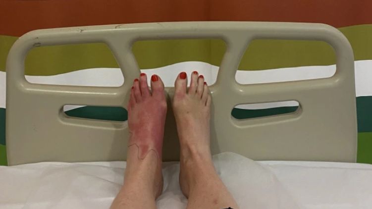 Sok z limonki może wywoływać poważne poparzenia