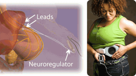 Nowy sposób walczenia z nadwagą 1