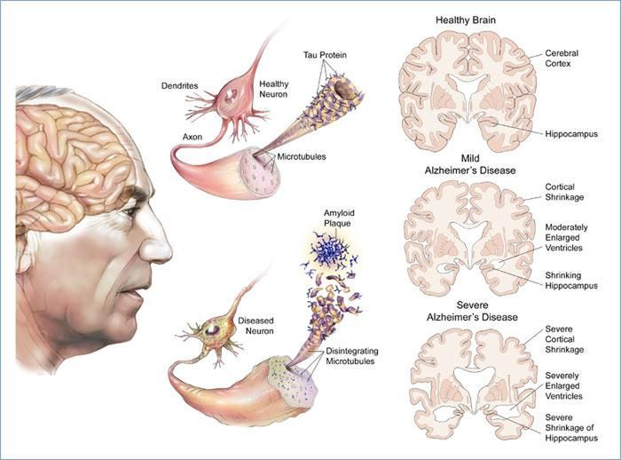 Alzheimer możliwy do wykrycia wcześniej 2