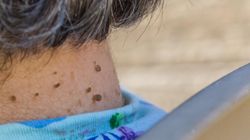 Masz włókniaki na szyi? Naukowcy odkryli pewną prawidłowość