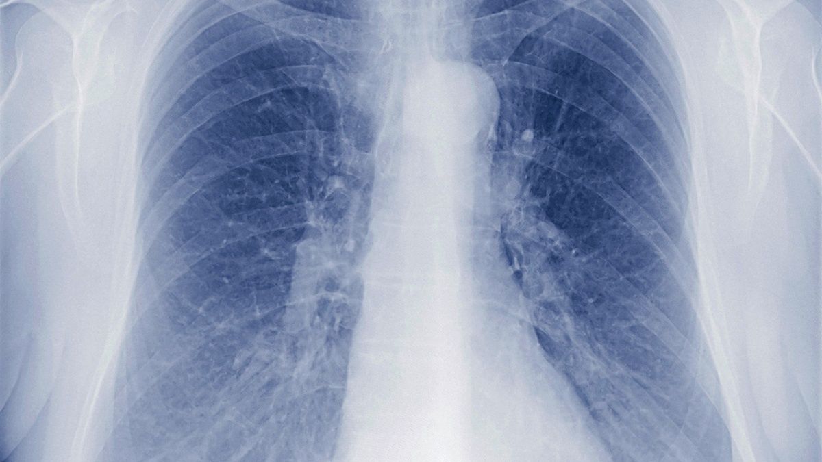Koronawirus może na stałe uszkodzić płuca? Lekarze nie są pewni