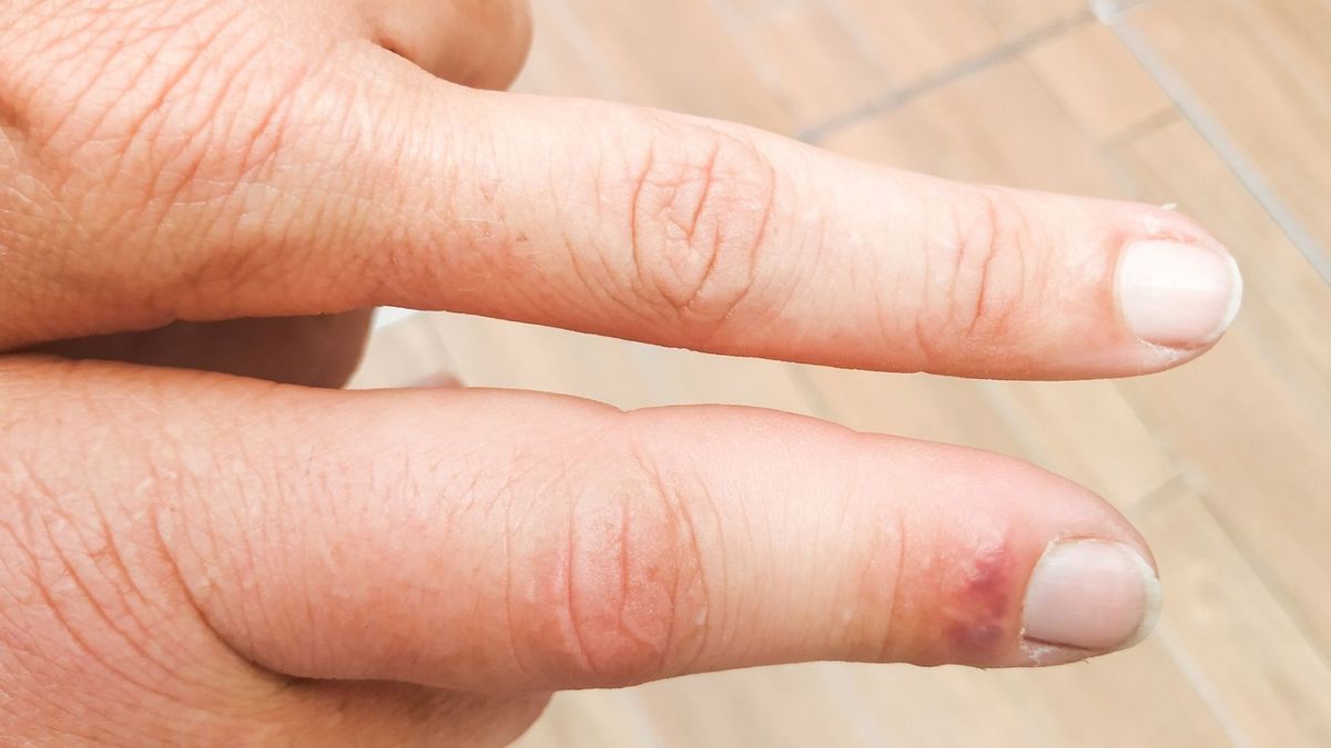 Tętniak może dawać mylne objawy, łatwo je zbagatelizować