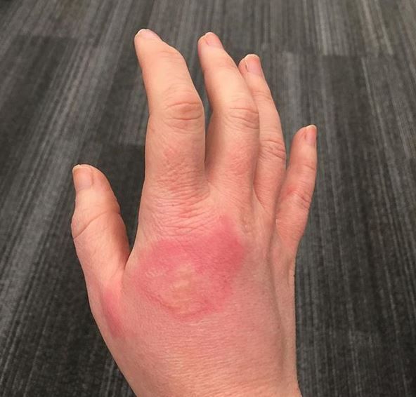 Sok z limonki może wywołać poparzenie