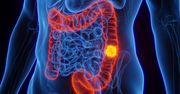 Może "zabijać" komórki raka jelit. Obiecujące badania przy udziale Polaków