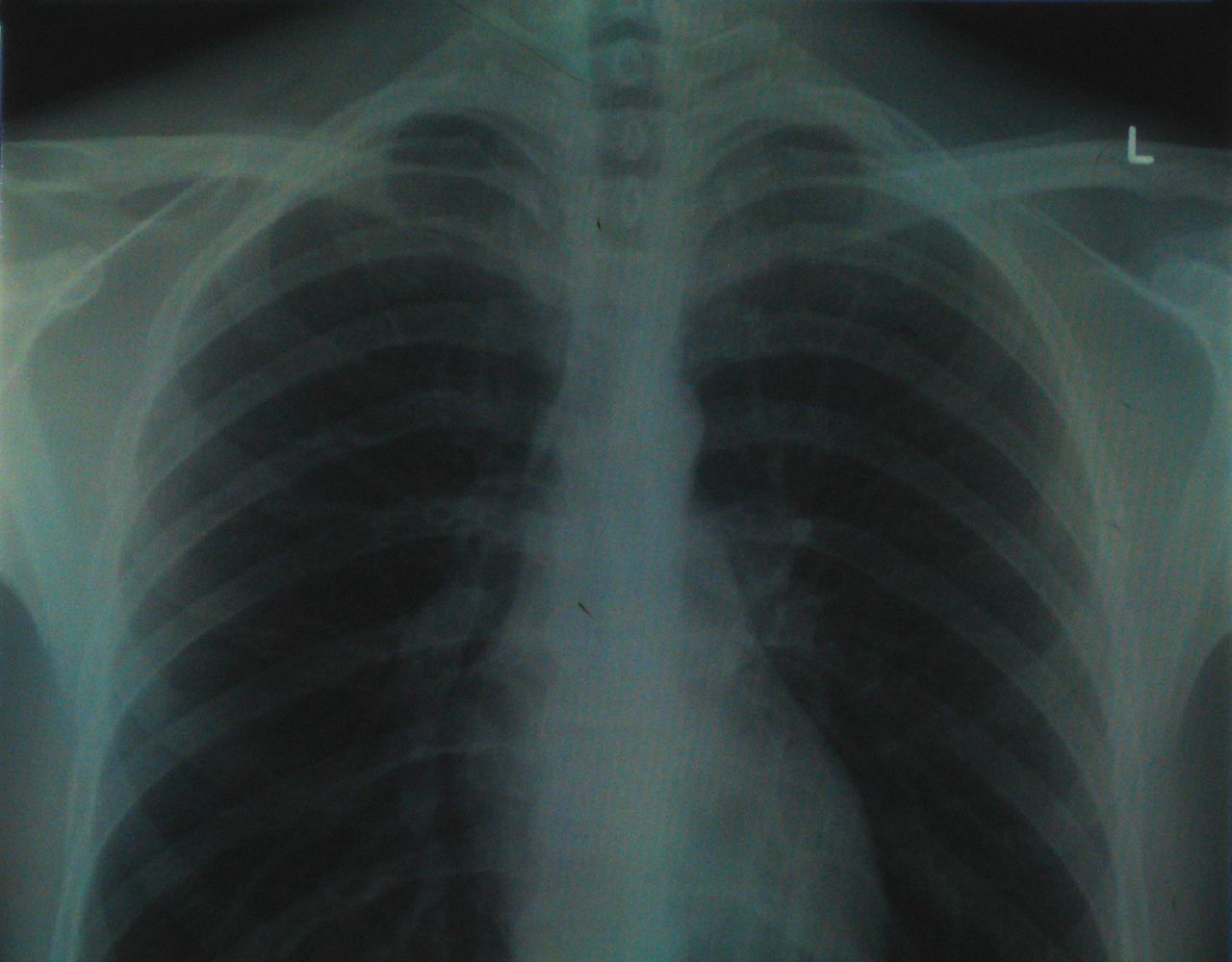 W przyszłości chore płuca wymienimy na nowe - sztuczne