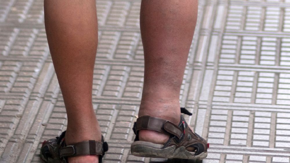 Objawy marskości wątroby widać na nogach