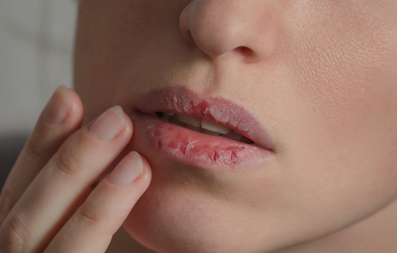 Jak poradzić sobie ze spierzchniętymi ustami? 