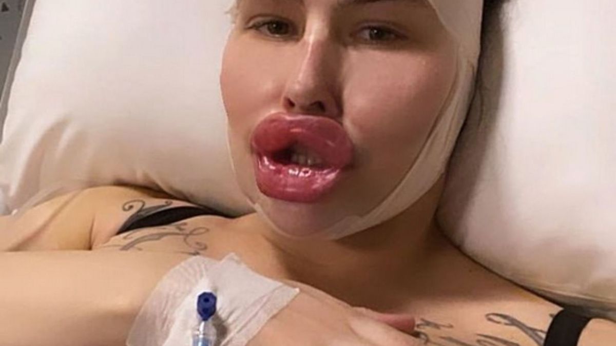 Powiększyła nie tylko usta. Lekarze nie chcą już jej widzieć