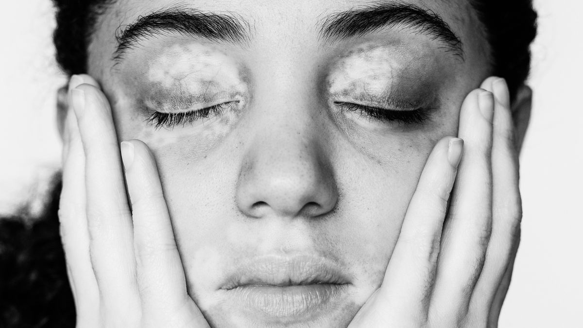 Julia Kaczorowska pokazuje, jak wyglądają „WZORY” na ciele osób z bielactwem 1