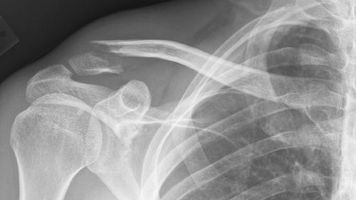 FlexBone – materiał do łatania dziur w kościach 1