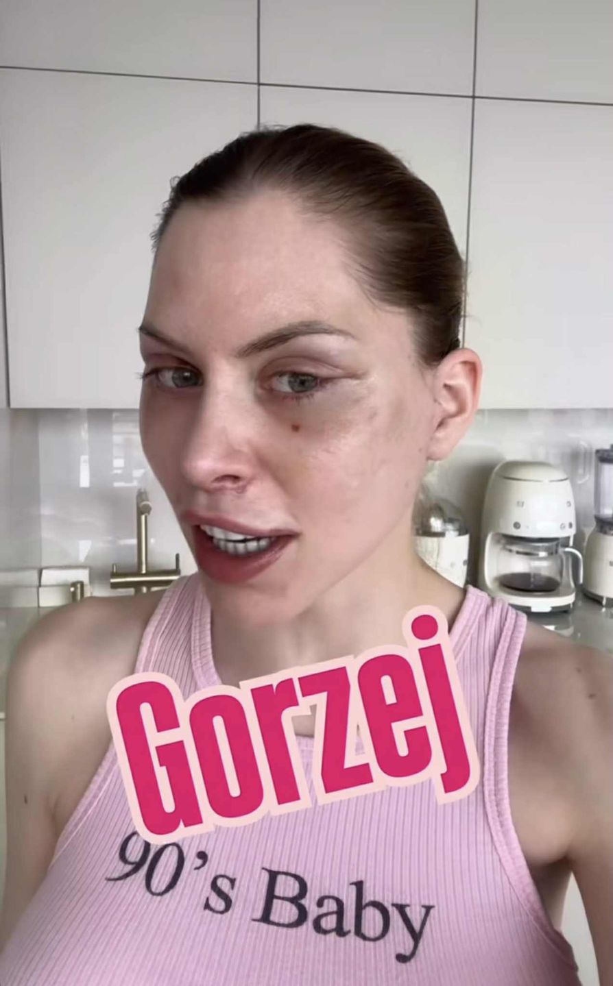 Julia von Stein pokazała zliftingowaną twarz 13 dni po operacji