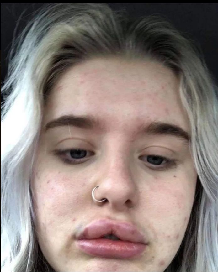 Usta 17-latki po wstrzyknięciu wypełniacza