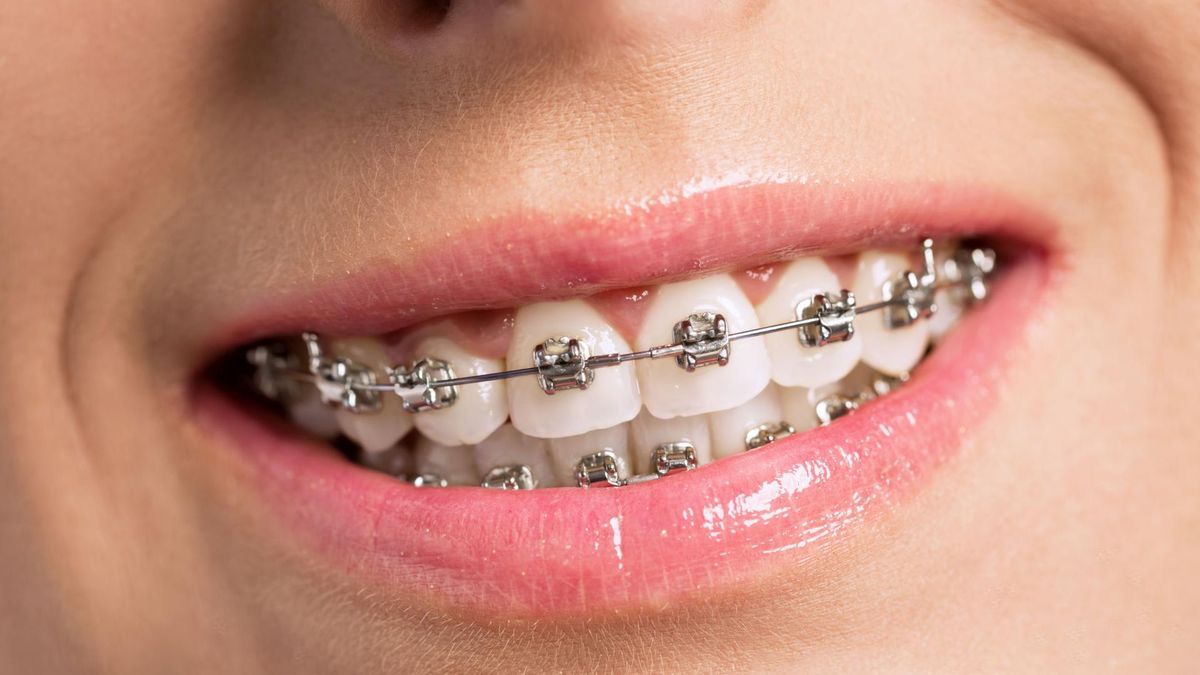 aparat ortodontyczny u starszych ludzi