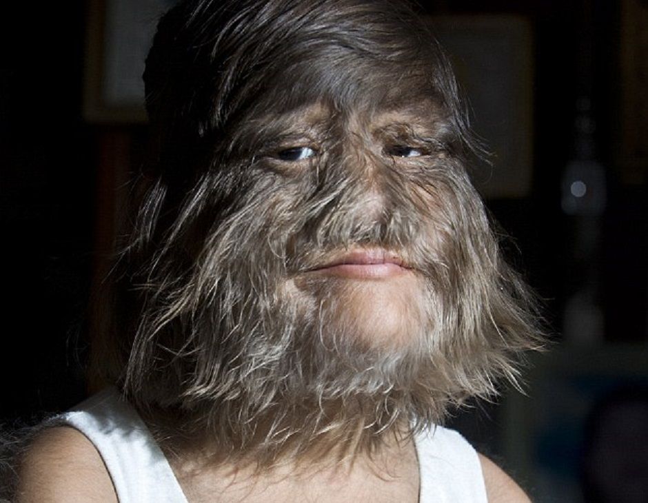 Najbardziej owłosiona dziewczynka na świecie. Wiemy, co słychać u Supatry Sasuphan