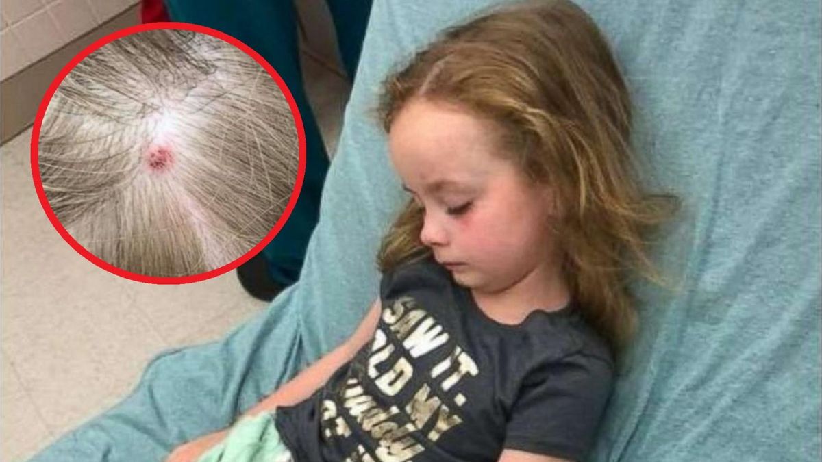 5-latkę nagle dopadł paraliż. Wszystko się wyjaśniło, gdy to odkryli na głowie