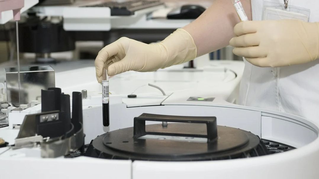 Wskaźnik eGFR jest szacowanym przesączaniem kłębuszkowym. Badanie miary filtracji kłębuszkowej eGFR pozwala wykryć przewlekłe choroby nerek.