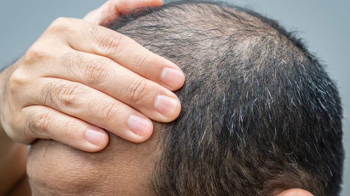 Łysiejący mężczyzna