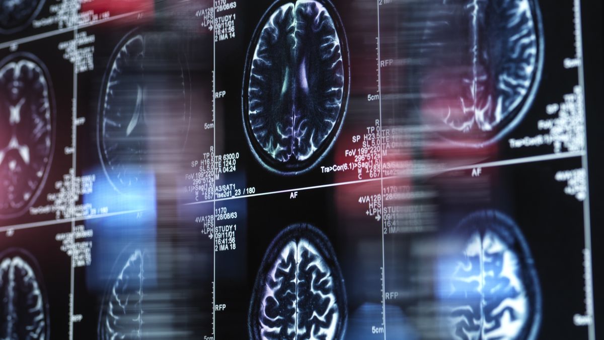 Alzheimer's and dementia research, conceptual image
Alzheimer's and dementia research, conceptual image. Magnetic resonance imaging (MRI) scan of a human brain on a screen
TEK IMAGE/SCIENCE PHOTO LIBRARY
ageing process, alzheimers, analysis, biomedicine, computer screen, connections, diagnosis, disease, health, medical examination, memory, neurology, new medicines, pharmaceutical research, pharmacology