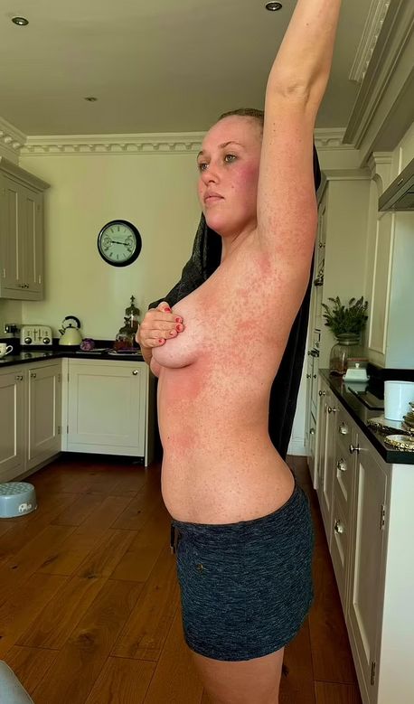 Wysypka utrzymywała się przez ponad tydzień