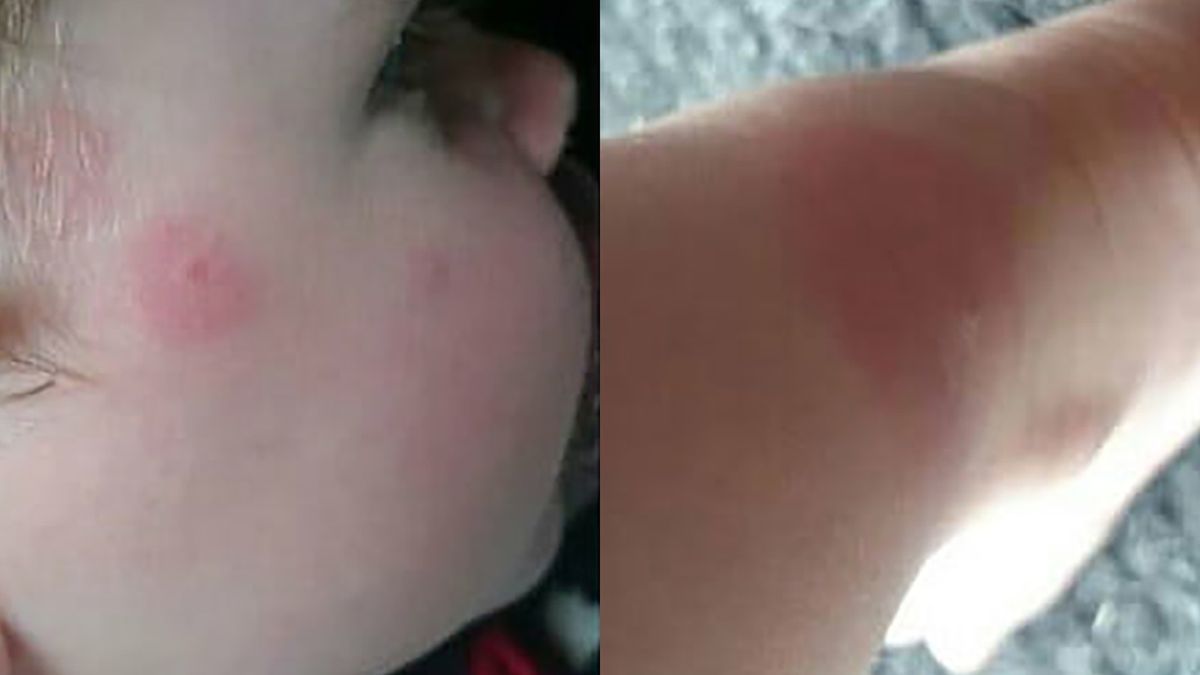 Karen McGregor zauważyła u swojego syna dziwną wysypkę