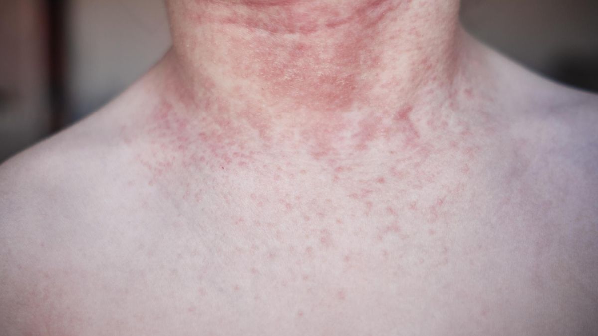 Choroba groźna nawet po wyleczeniu. Podwyższone ryzyko udaru mózgu i zawału serca