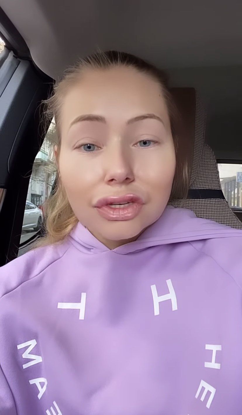 Agata Rubik pokazała, jak wyglądałaby z wypełniaczami w twarzy