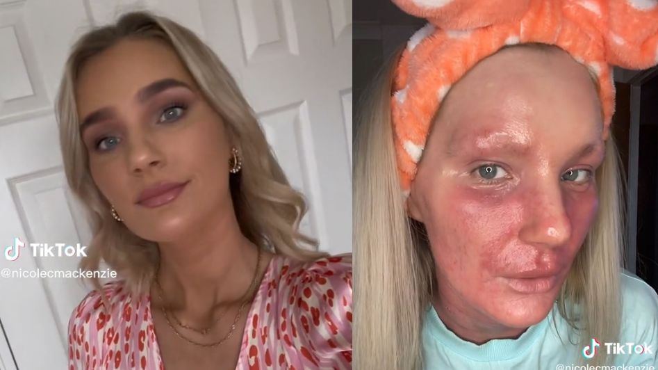 Maść ze sterydami wypaliła jej skórę. 26-latka owija się folią, by zatrzymać odrobinę wilgoci