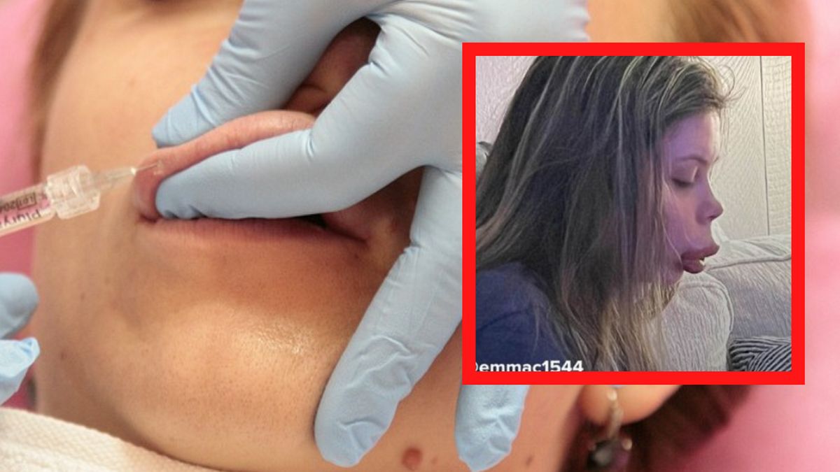 Powiększyła usta. Wystąpiła u niej reakcja alergiczna. 