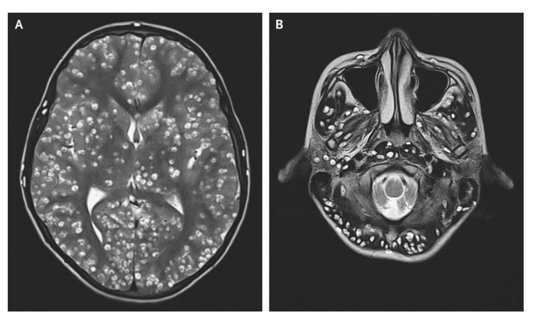 Zdjęcia mózgu pacjenta z widocznymi otorbionymi larwami 