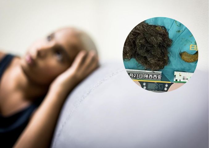 Lekarze znaleźli w brzuchu nastolatki trzykilogramową kulę włosów. Dziewczyna cierpi na zespół Pica