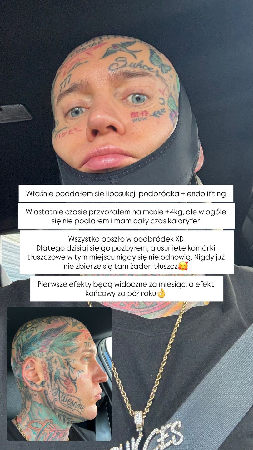 Stifler poddał się liposukcji podbródka