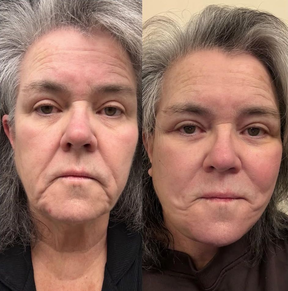 Rosie O'Donnell "przed" i "po" liftingu