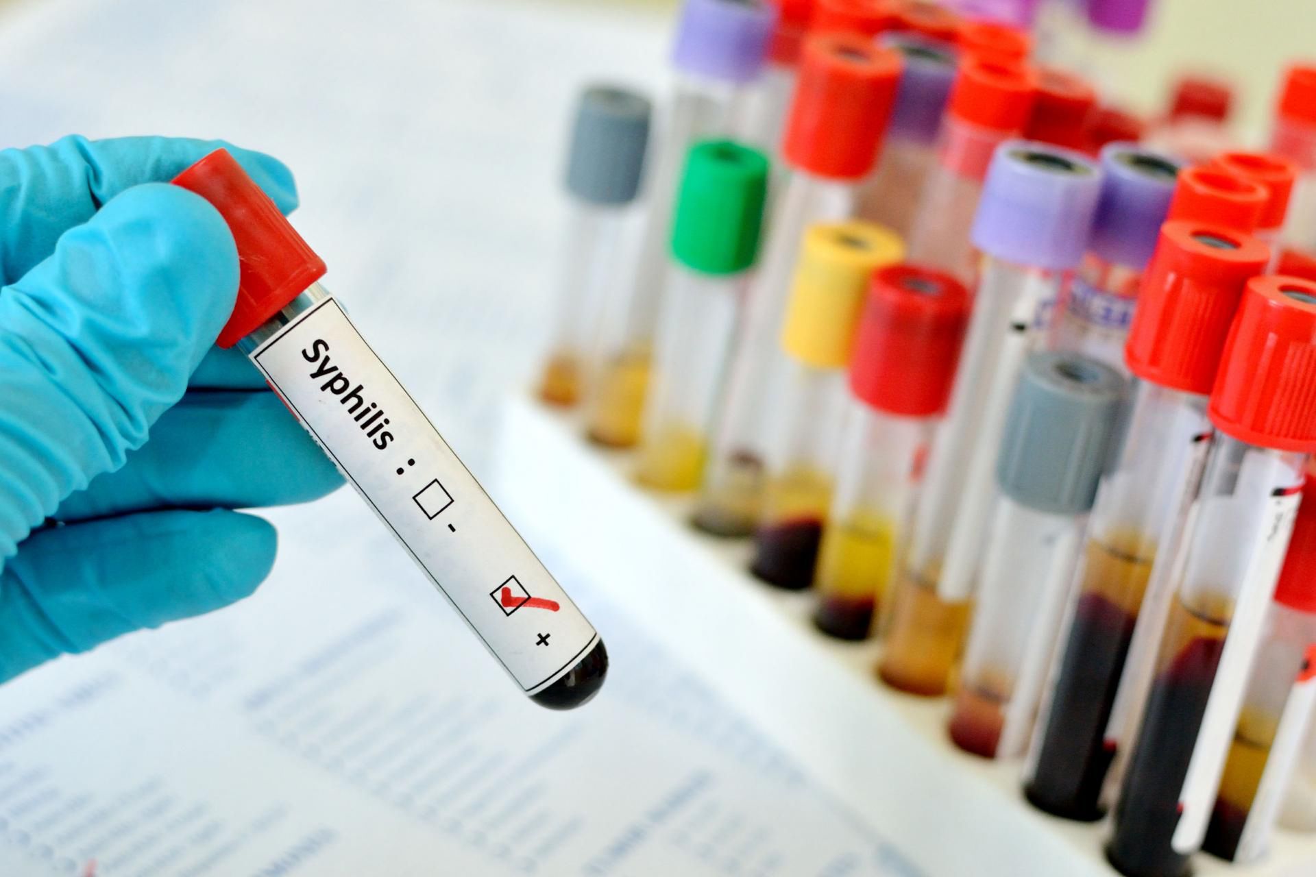 Zachorowania na kiłę są coraz częściej rozpoznawane