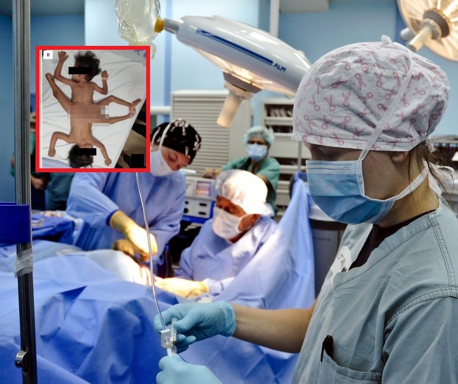 "Pajęcze" bliźnięta syjamskie. Zdarza się raz na 2 mln