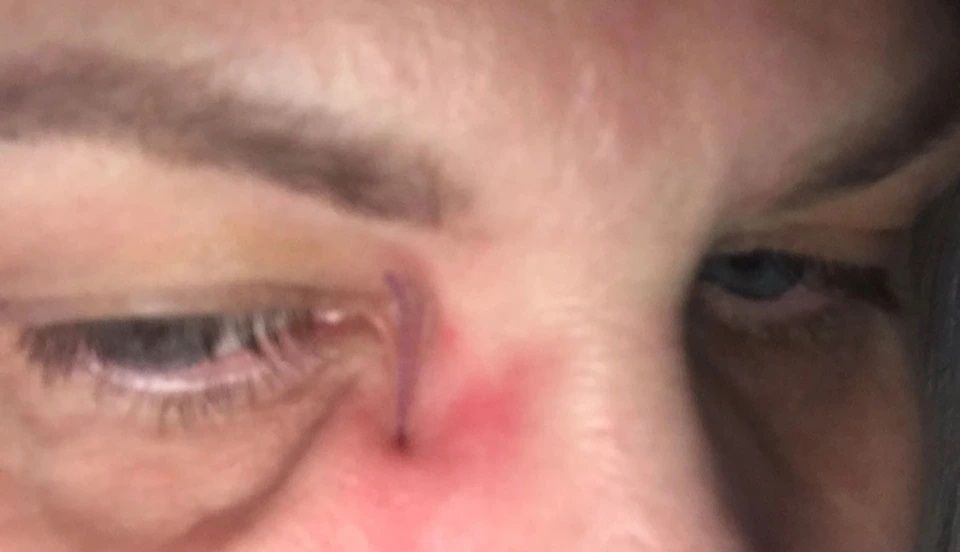 Jedna z nici pękła tuż przy oku Barbary