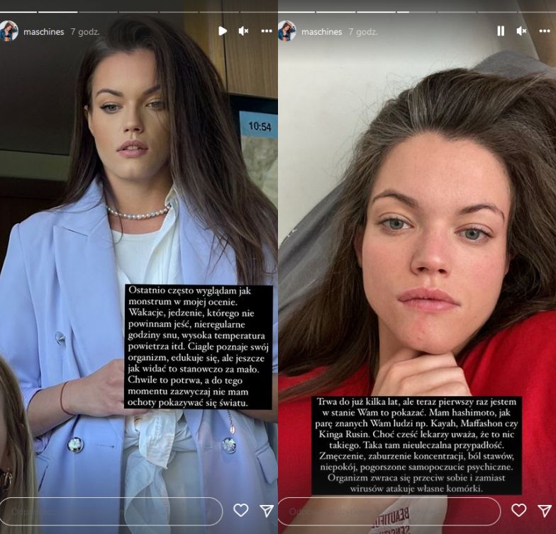 Agnieszka Skrzeczkowska otwiera się w temacie Hashimoto